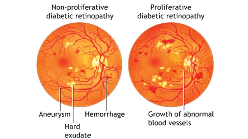 Diabetic retinopathy